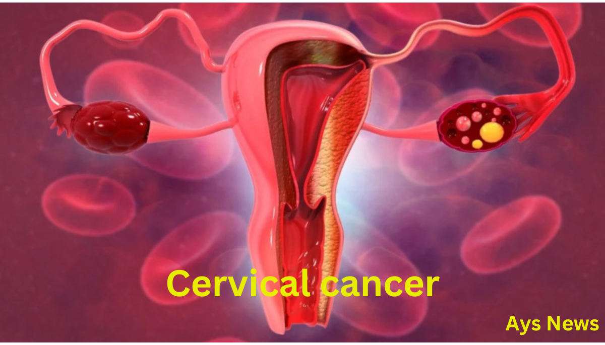 What Is Cervical Cancer? | 5 Plus Signs Understandig
