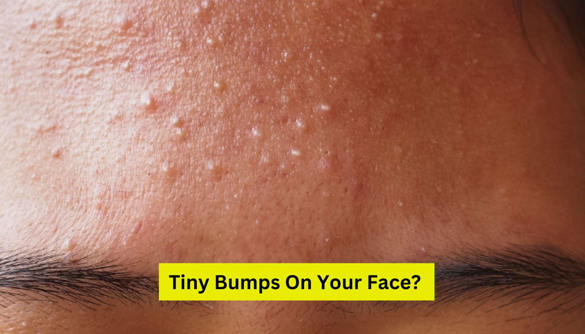 Understanding Tiny Bumps On Your Face: Not Just Acne